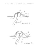 Methods And Devices For Treating The Left Atrial Appendage diagram and image