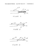 Methods And Devices For Treating The Left Atrial Appendage diagram and image