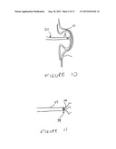 Methods And Devices For Treating The Left Atrial Appendage diagram and image