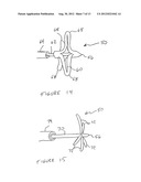 Methods And Devices For Treating The Left Atrial Appendage diagram and image