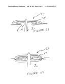 Methods And Devices For Treating The Left Atrial Appendage diagram and image