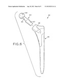 MODULAR ORTHOPAEDIC COMPONENT CASE diagram and image