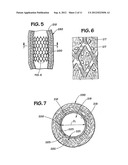 METHOD FOR MAKING GROOVES ON A LUMINAL SURFACE OF AN INTRAVASCULAR STENT diagram and image