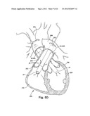 BLOOD PUMP diagram and image