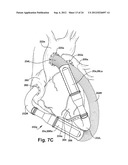 BLOOD PUMP diagram and image