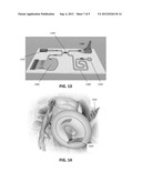 IMPLANTABLE SENSOR diagram and image