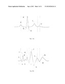 Method and Apparatus for Acquiring Data Relating to a Physiological     Condition of a Subject When Chest Wall Access is Limited diagram and image