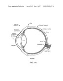 IMPLANTABLE OPHTHALMIC MEMS SENSOR DEVICES AND METHODS FOR EYE SURGERY diagram and image