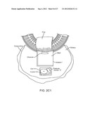 IMPLANTABLE OPHTHALMIC MEMS SENSOR DEVICES AND METHODS FOR EYE SURGERY diagram and image