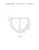 DELIVERY OF BIOLOGICAL COMPOUNDS TO ISCHEMIC AND/OR INFARCTED TISSUE diagram and image