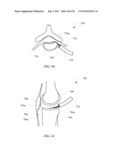 THERMALLY ADJUSTABLE SURGICAL TOOL, BALLOON CATHETERS AND SCULPTING OF     BIOLOGIC MATERIALS diagram and image