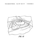 System and method for preparing a lenticular or corneal implant diagram and image