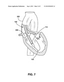 Perfusion Dilation Catheter System and Methods of Use diagram and image