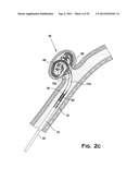 SYSTEM AND METHOD FOR MECHANICALLY POSITIONING INTRAVASCULAR IMPLANTS diagram and image