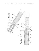 SYSTEM AND METHOD FOR MECHANICALLY POSITIONING INTRAVASCULAR IMPLANTS diagram and image