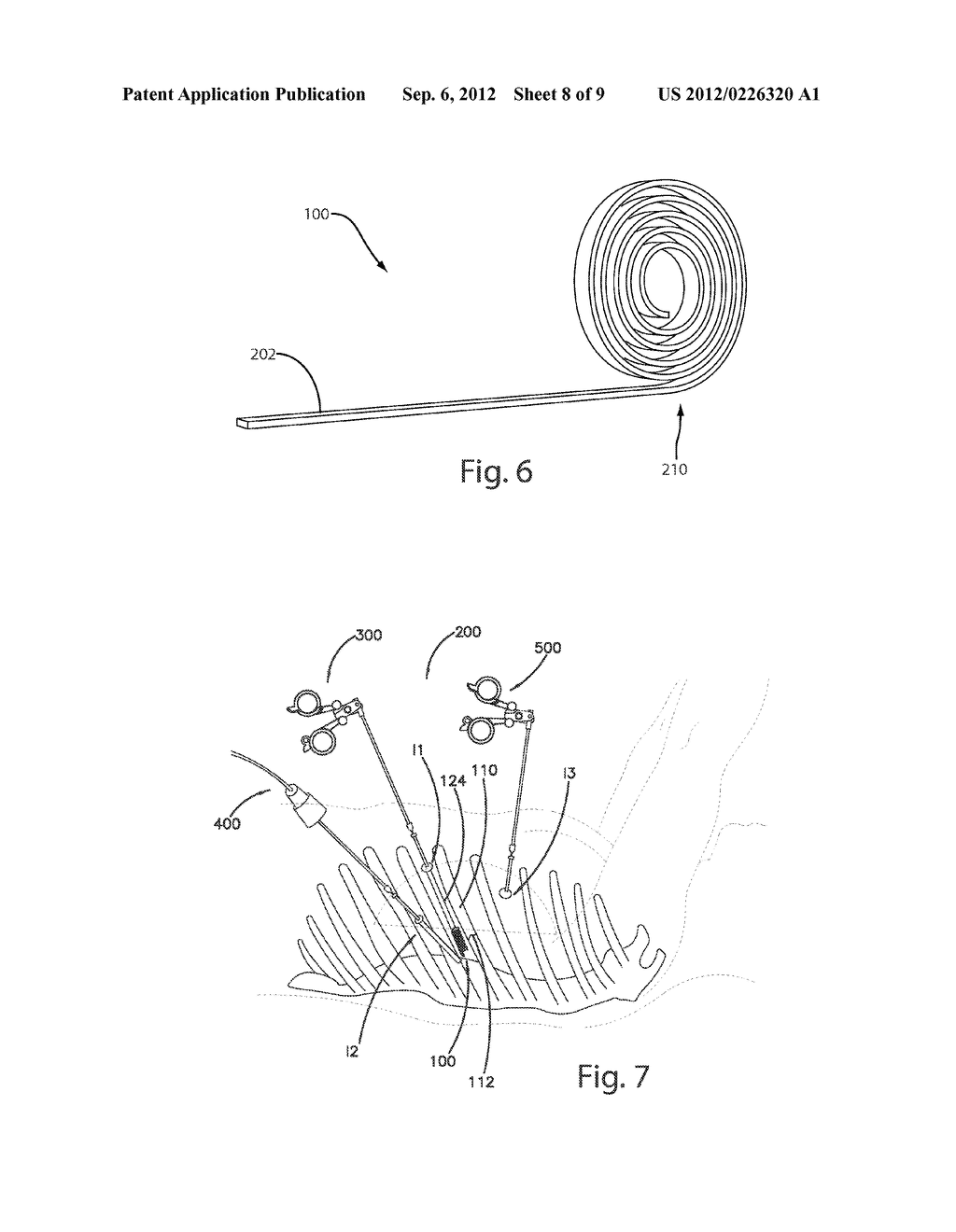 EXPANDABLE BONE FIXATION IMPLANT - diagram, schematic, and image 09