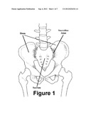 Method for Minimally Invasive Treatment of Unstable Pelvic Ring Injuries     with an Internal Anterior Fixator and Posterior Iliosacral Screws diagram and image