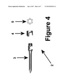 Method for Minimally Invasive Treatment of Unstable Pelvic Ring Injuries     with an Internal Anterior Fixator and Posterior Iliosacral Screws diagram and image