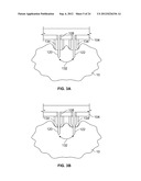 METHODS AND DEVICES FOR TREATING TISSUE diagram and image