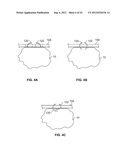 METHODS AND DEVICES FOR TREATING TISSUE diagram and image