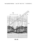 METHODS AND DEVICES FOR TREATING TISSUE diagram and image