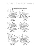 Methods and Devices for Treating Sleep Apnea and Snoring diagram and image