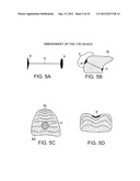 Methods and Devices for Treating Sleep Apnea and Snoring diagram and image