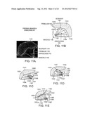 Methods and Devices for Treating Sleep Apnea and Snoring diagram and image