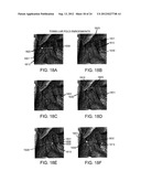 Methods and Devices for Treating Sleep Apnea and Snoring diagram and image