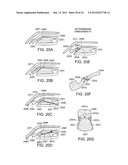 Methods and Devices for Treating Sleep Apnea and Snoring diagram and image