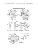 Methods and Devices for Treating Sleep Apnea and Snoring diagram and image