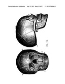 PRODUCING A THREE DIMENSIONAL MODEL OF AN IMPLANT diagram and image