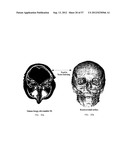 PRODUCING A THREE DIMENSIONAL MODEL OF AN IMPLANT diagram and image