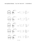 PRODUCING A THREE DIMENSIONAL MODEL OF AN IMPLANT diagram and image