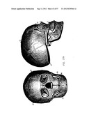 PRODUCING A THREE DIMENSIONAL MODEL OF AN IMPLANT diagram and image