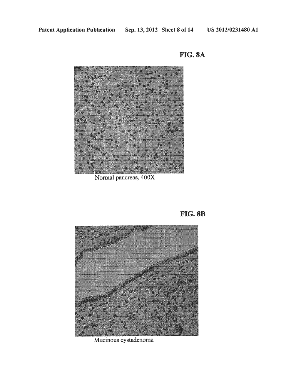 MATERIALS AND METHODS FOR THE DIFFERENTIAL DIAGNOSIS OF PACREATIC LESIONS - diagram, schematic, and image 09