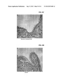 MATERIALS AND METHODS FOR THE DIFFERENTIAL DIAGNOSIS OF PACREATIC LESIONS diagram and image