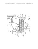 METHOD AND DEVICE FOR PROCESSING A CARCASS PART OF SLAUGHTERED POULTRY diagram and image