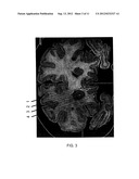 METHOD OF TREATING DEPRESSION, MOOD DISORDERS AND ANXIETY DISORDERS USING     NEUROMODULATION diagram and image