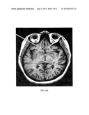 METHOD OF TREATING DEPRESSION, MOOD DISORDERS AND ANXIETY DISORDERS USING     NEUROMODULATION diagram and image