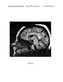 METHOD OF TREATING DEPRESSION, MOOD DISORDERS AND ANXIETY DISORDERS USING     NEUROMODULATION diagram and image