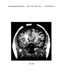 METHOD OF TREATING DEPRESSION, MOOD DISORDERS AND ANXIETY DISORDERS USING     NEUROMODULATION diagram and image