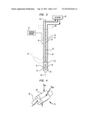 Method and Apparatus for Treatment of Hypertension Through Percutaneous     Ultrasound Renal Denervation diagram and image