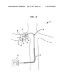 Method and Apparatus for Treatment of Hypertension Through Percutaneous     Ultrasound Renal Denervation diagram and image