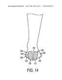 SYSTEM FOR TREATMENT OF PLANTAR FASCIITIS diagram and image