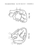 ABLATIVE TREATMENT OF THE HEART TO IMPROVE PATIENT OUTCOMES FOLLOWING     SURGERY diagram and image