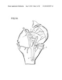 METHOD FOR IMPROVING BLOOD FLOW IN BONE HEAD diagram and image