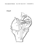 METHOD FOR IMPROVING BLOOD FLOW IN BONE HEAD diagram and image