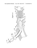 APPARATUS AND METHOD FOR TREATING OCCLUDED VASCULATURE diagram and image