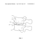 SURGICAL TOOL FOR ADJUSTING A SPINAL IMPLANT diagram and image